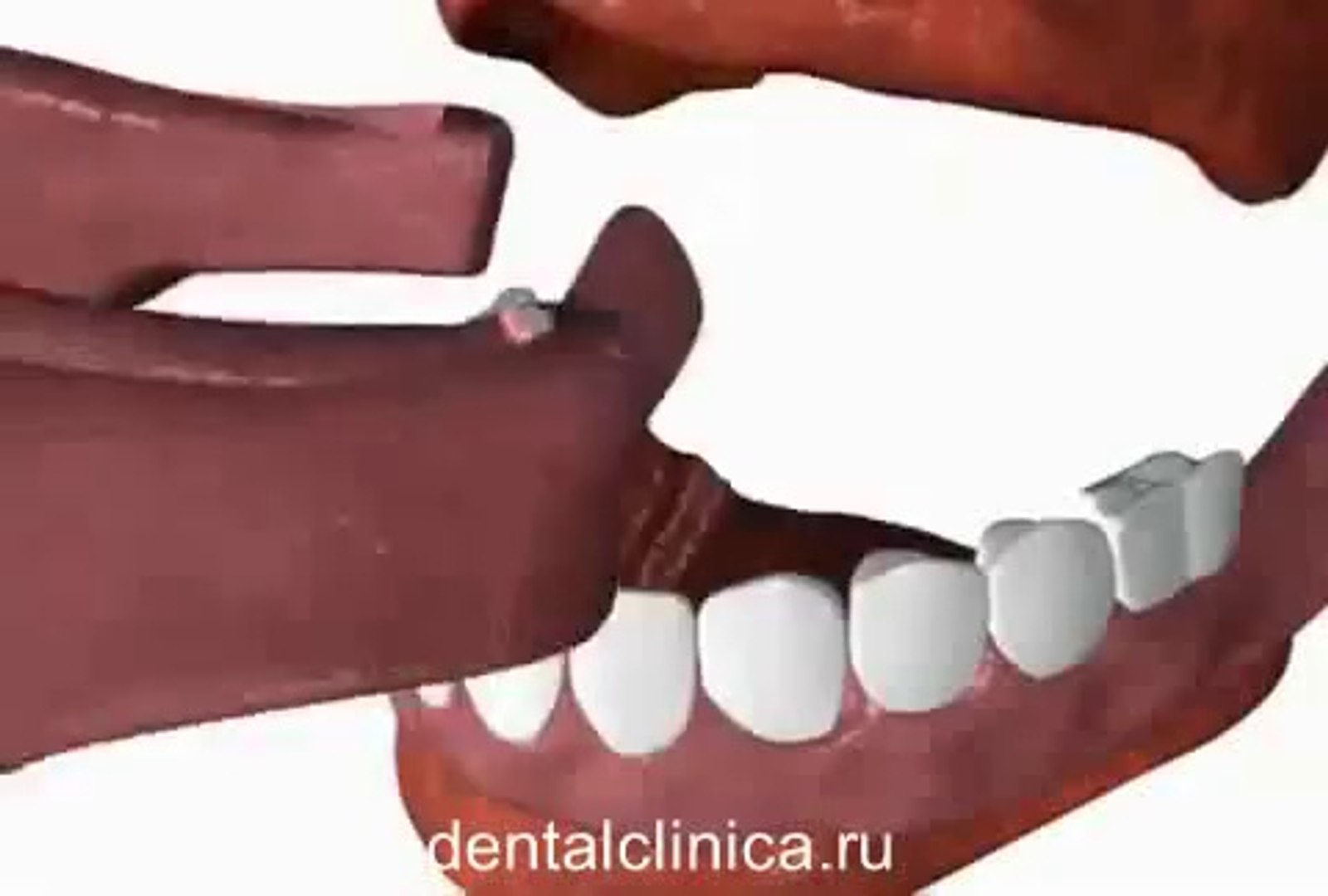 ⁣European Clinic of Aesthetic Dentistry Стоматология лечение зубов в Санкт-Петербурге Москве импланта
