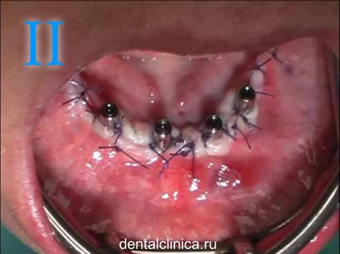 European Clinic of Aesthetic Dentistry in Budapest “Jewel Dental” “AVANTE” Dentistry treatment prosthesis implantation plastic surgery Express therapy filling bone healing tourism health leisure