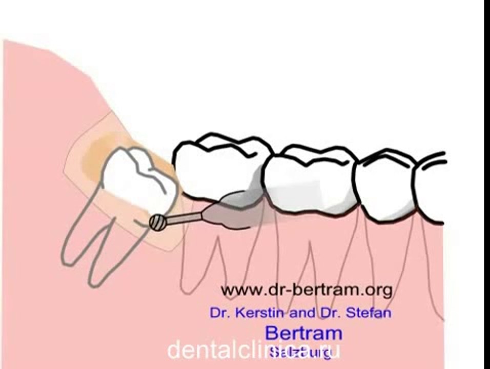 European Clinic of Aesthetic Dentistry in Budapest “Jewel Dental” “AVANTE” dental treatment prosthesis implantation plastic surgery Express therapy filling bone healing tourism health leisure
