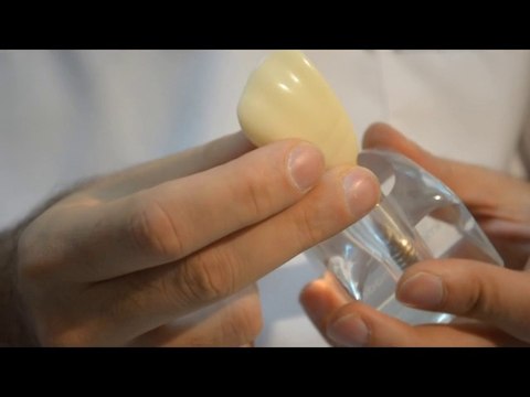 implant Diş Yapımı, implant ameliyatı ve en iyi implant markaları.Türkiyede implant fiyatı