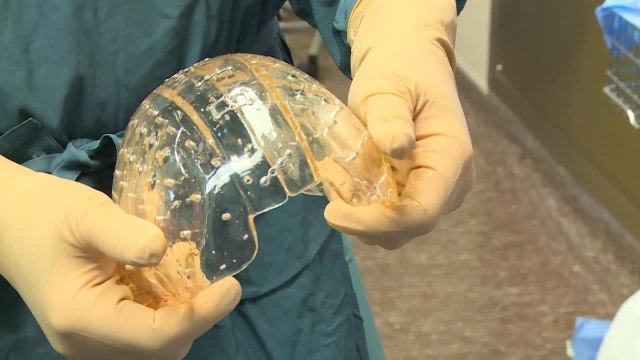 Un crâne imprimé en 3D posé sur une femme aux Pays-Bas