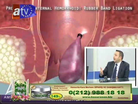 Hemoroid (Basur) Tedavisi. Hemorita Kara Merhem.