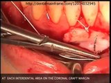 FREE GINGIVAL GRAFT SURGERY BY DR JAVIER GARCIA FERNANDEZ -SPANISH VIDEO SOURCE