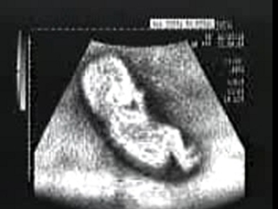 Echographie