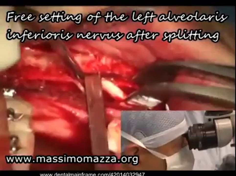 ORTHOGNATIC SURGERY BILATERAL SAGITTAL SPLIT OSTEOTOMY