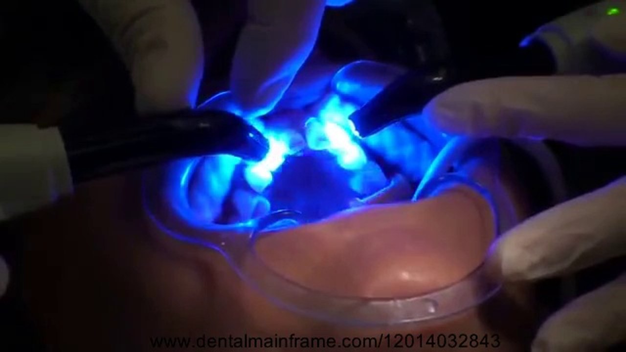 VENEER REPLACEMENT PROCEDURE -RYAN SELLINGER