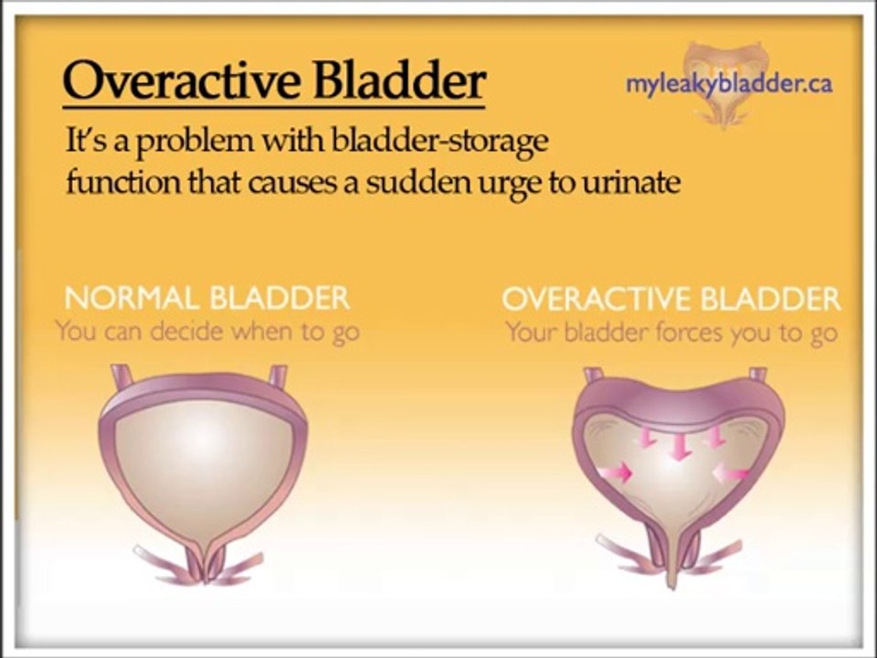 Overactive blabber | Overactive Bladder Symptoms | Overactive Bladder Treatment