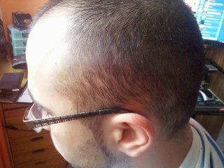 Haartransplantation Türkei FUE Erfahrungsbericht