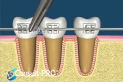Dişler ortodontik tedavi ile nasıl hareket eder Dr. Ahmet KELEŞ