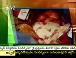 Yahsoda Hospital | First Heart Transplant Surgery in India, Andhra Pradesh
