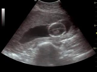 Что происходит на 17 неделе беременности