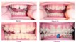 Cosmetic Orthodontics for Adults, Dr. Stephen Poss, Dentist, Franklin, Nashville, Brentwood, TN