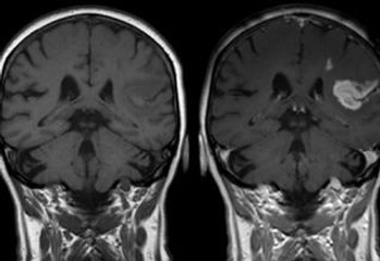 Insomnia Increases Risk Of Stroke In Youth