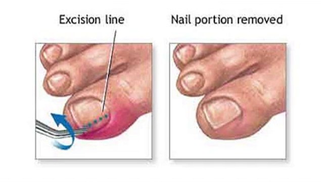 Saginaw, Bay City and Essexville, MI - Ingrown Toenail - Podiatrist Andrew Cohen