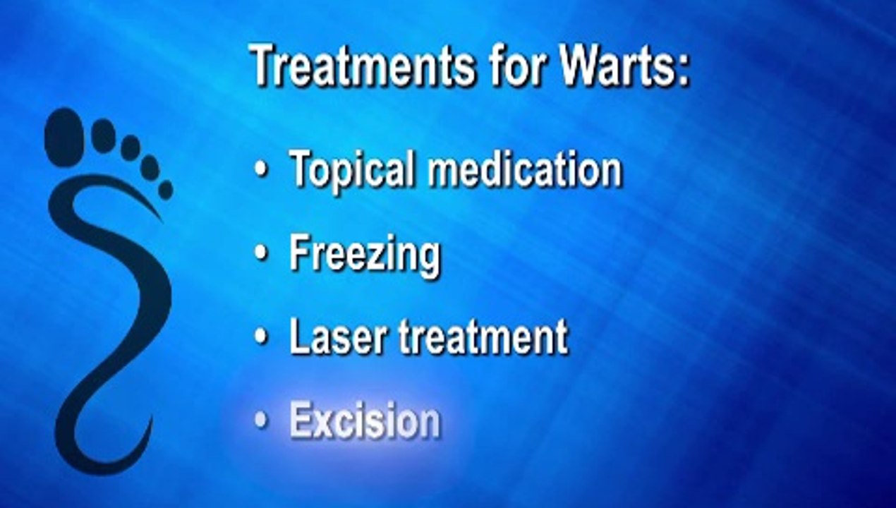 Saginaw, Bay City and Essexville, MI - Foot Wart - Podiatrist Andrew Cohen
