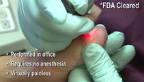 Laser for Fungal Toenails -  Parma, Rocky River, Independence, OH - Podiatrist Joseph Ripepi