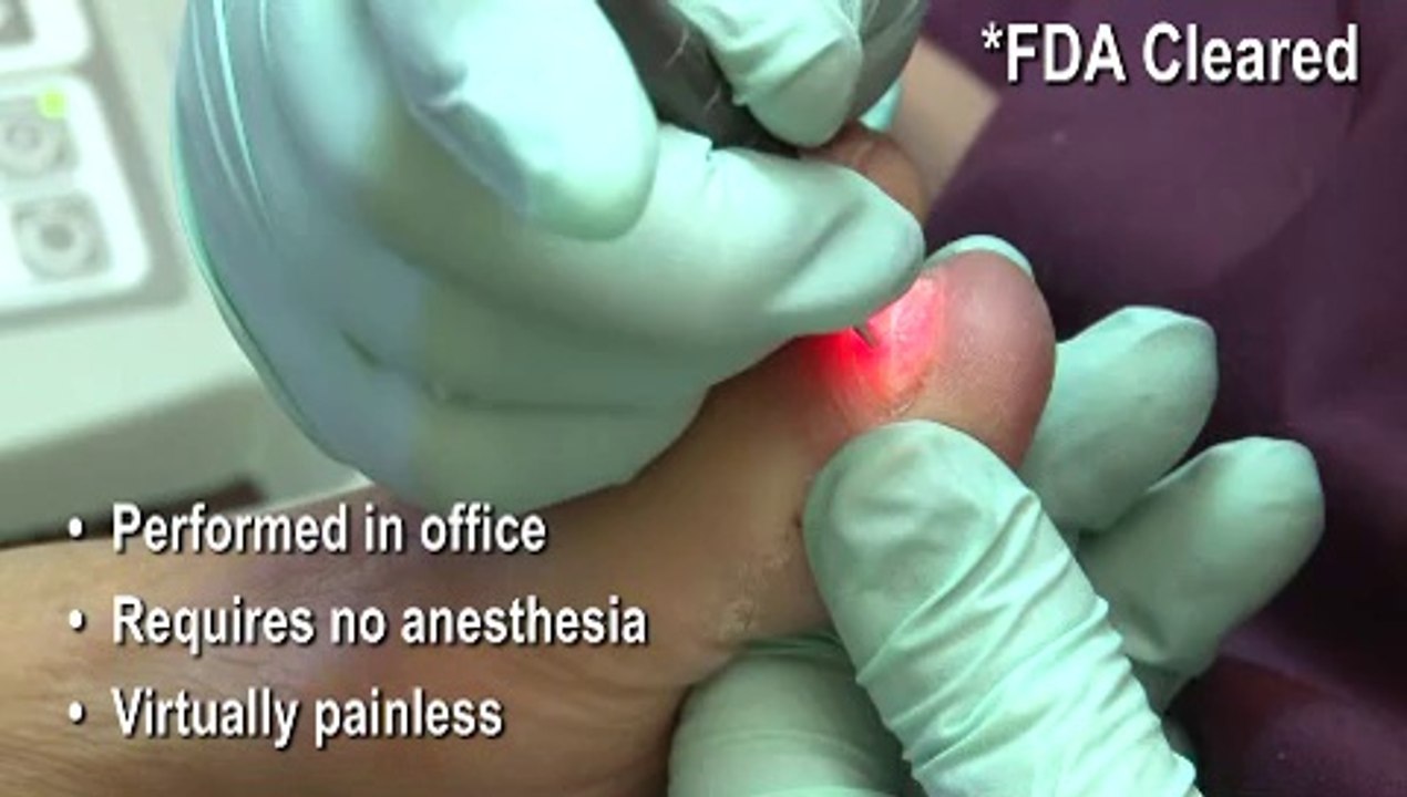Laser for Fungal Toenails -  Parma, Rocky River, Independence, OH - Podiatrist Joseph Ripepi