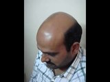 Hair transplant, Lahore, Pakistan - www.fuepakistan.com