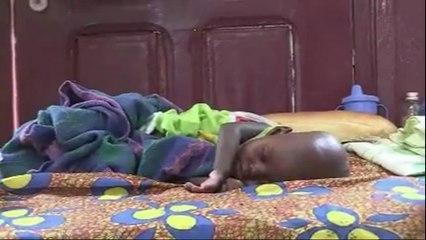 Bangui: plusieurs cas grave de malnutritions infantile