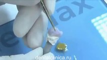 Лечение зубов Коронка зуба технология IPS e max CAD Glaze in European Clinic of Aesthetic Dentistry