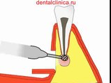 Лечение зубов резекция корня зуба, хирургическая стоматология, уроки