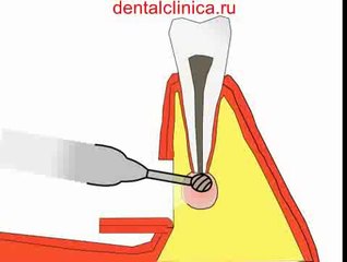 Лечение зубов резекция корня зуба, хирургическая стоматология, уроки