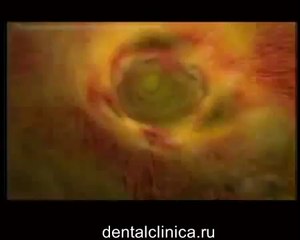 Лечение зубов, эстетическая стоматология, реставрация hi-tech моделирование Центр Имплантологии и Ресторативной Стоматологии