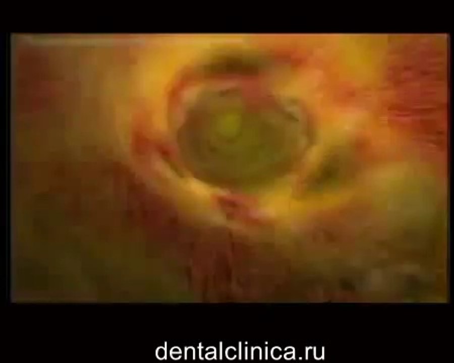 Лечение зубов, эстетическая стоматология, реставрация hi-tech моделирование Центр Имплантологии и Ресторативной Стоматологии