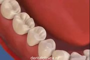 Лечение пульпита зуба Реконструктивная стоматология European Clinic of Aesthetic Dentistry