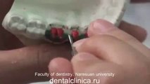 Клиника Имплантологии и Эстетической Стоматологии Протезирование Mandibular posterior teeth Лечение зубов в Клинике эстетической стоматологии