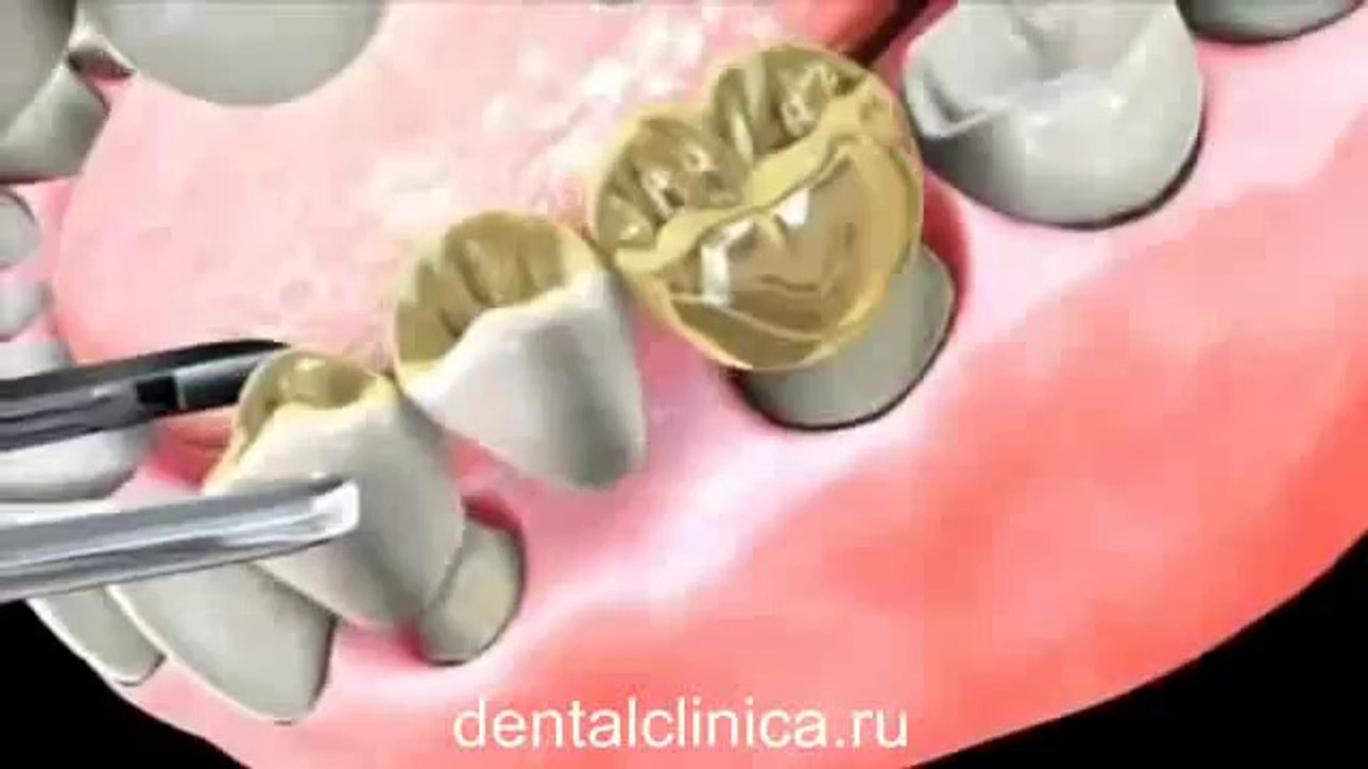 ⁣Международная клиника стоматологии имплантологии Протезирование зубные мосты функциональная стоматол
