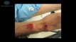 San Diego Motorcycle Accident Victim in San Diego Explains Why He Chose Attorney Mark Blane