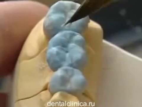 Международная клиника стоматологии имплантологии Протезирование зубов металлокерамика керамика система NobelRondo™ Zirconia