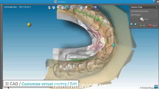 Протезирование зубов, моделирование hi-tech DWOS от European Clinic of Aesthetic Dentistry Международная клиника стоматологии имплантологии