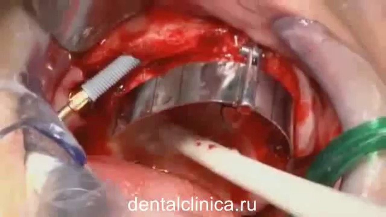 Семинар hi-tech Nobel Biocare стоматология эволюция, новые концепции лечения European Clinic of Aesthetic Dentistry in Budapest “Jewel Dental” “AVANTE”