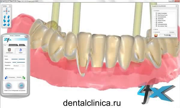 Протезирование имплантация, CAD моделирование, Клиника эстетической стоматологии в Будапеште