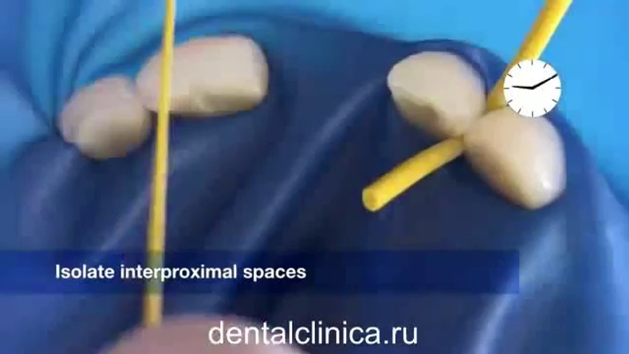 Реконструктивная Стоматология hi-tech Lab композитные материалы европейское качество Международная клиника стоматологии имплантологии