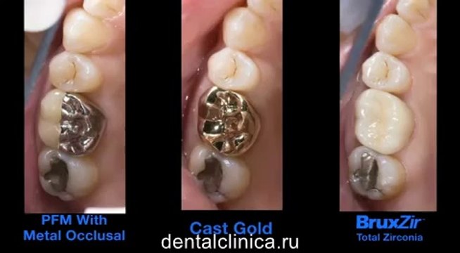 Стоматология Семинар to BruxZir Total Zirconia Коронки керамика металлокерамика European Clinic of Aesthetic Dentistry in Budapest “Jewel Dental” “AVANTE” Dentist Medical Center