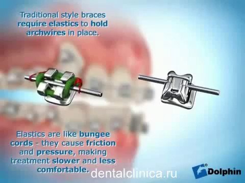 European Clinic of Aesthetic Dentistry in Budapest “Jewel Dental” “AVANTE” Стоматология ортодонтия hi-tech Damon System Красивая улыбка приятные цены хорошее настроение Международная клиника стоматологии имплантологии
