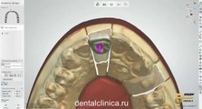 European Clinic of Aesthetic Dentistry in Budapest “Jewel Dental” “AVANTE” Dentist Medical Center Стоматология протезирование 3D моделирование, hi-tech made Lab, красивые улыбки