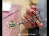 European Clinic  Dentistry in Budapest Jewel Dental AVANTE Эстетика улыбки CAD CAM моделирование, фрезерование из хрома, покрытие керамикой протезирование и имплантация порадуйте мир красивой улыбкой