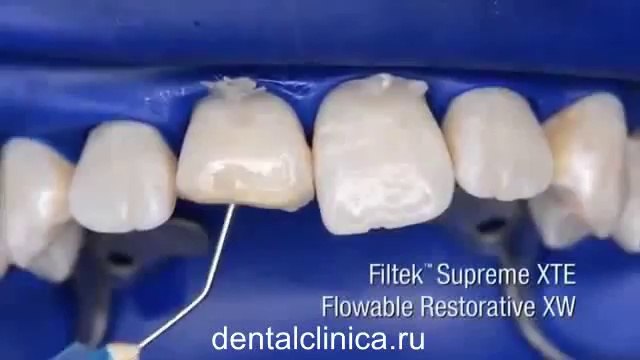 European Clinic Dentistry in Budapest Jewel Dental AVANTE Dentist Medical Center Эстетическая реконструкция hi-tech Filtek передних зубов в European Clinic of Aesthetic Dentistry Международная клиника стоматологии имплантологии