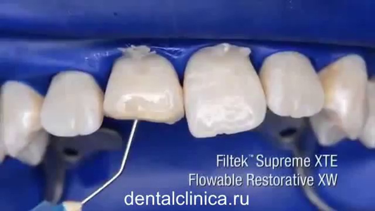 European Clinic  Dentistry in Budapest Jewel Dental AVANTE Dentist Medical Center Эстетическая реконструкция hi-tech Filtek передних зубов в European Clinic of Aesthetic Dentistry Международная клиника стоматологии имплантологии
