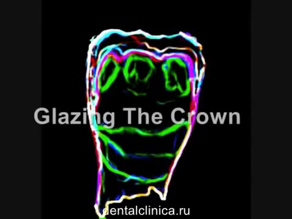 Эстетическая реконструкция hi-tech Glazing e max коронки зуба European Clinic  Dentistry in Budapest Jewel Dental AVANTE Dentist Medical Center Международная клиника имплантологии и протезирования