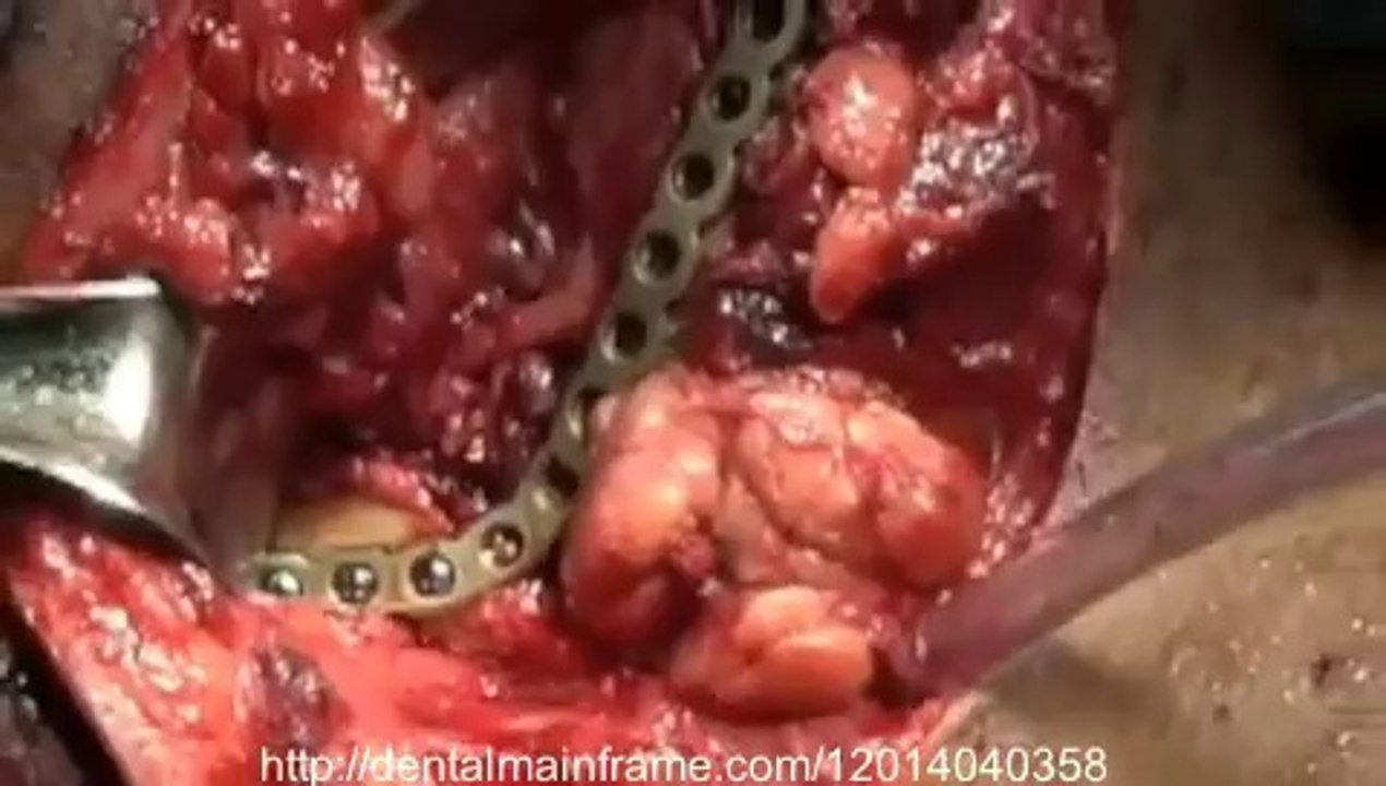Ameloblastoma_(new)