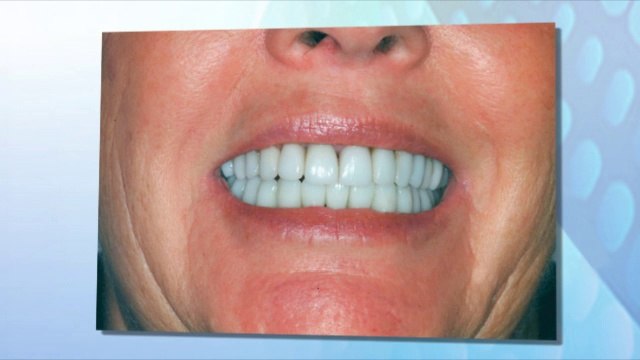 Root canals & Chipped teeth - Lakewood NJ Family Dental