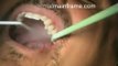 Mini Dental Implants - Single Tooth Replacement - Dr. Todd E. Shatkin_(new)