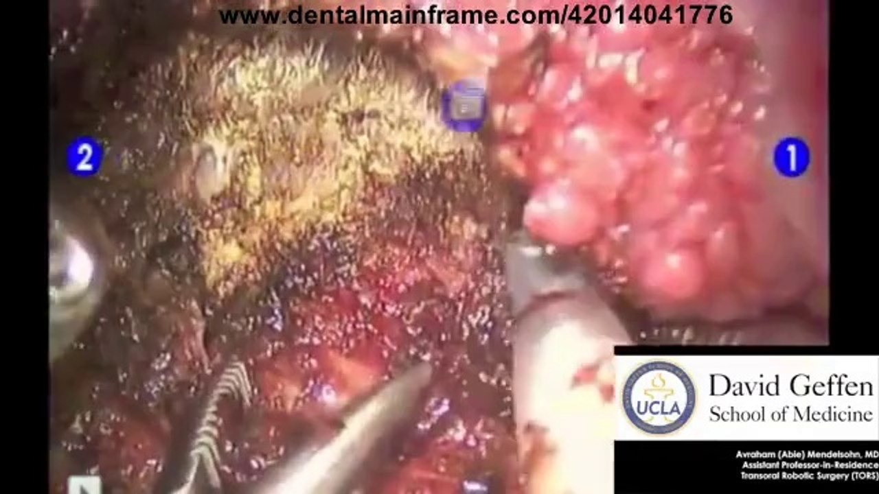 Tongue Cancer Surgery - transoral robotic surgery (TORS) - Partial Glossectomy_(new)