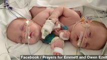 Formerly Conjoined Twins Released From Dallas Hospital