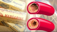 FDA proposes to ban trans fats due to health risks